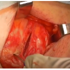 Тренажер для отработки пластики паховых грыж по Лихтенштейну