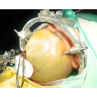 Симулятор-муляж черепа  с возможностью применения скобы  