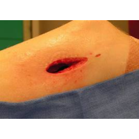 Тренажёр закрытия раны